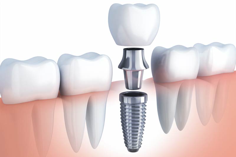 Implants Dentist in El Paso