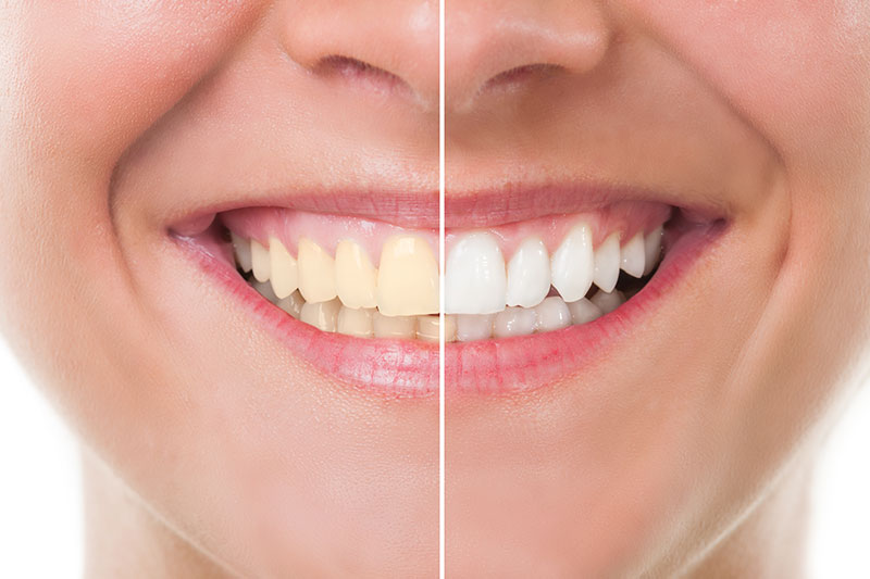 Teeth Whitening in El Paso