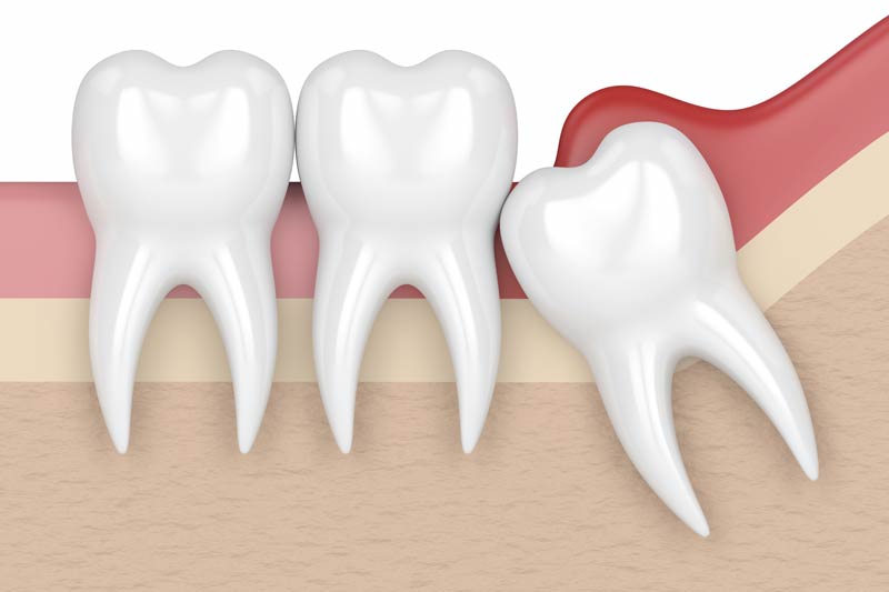 Wisdom Tooth Removal in El Paso